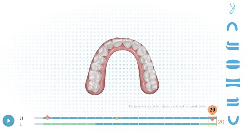 【歯科矯正レポ②】動画で確認！ゼニュムの治療計画が完成しました。